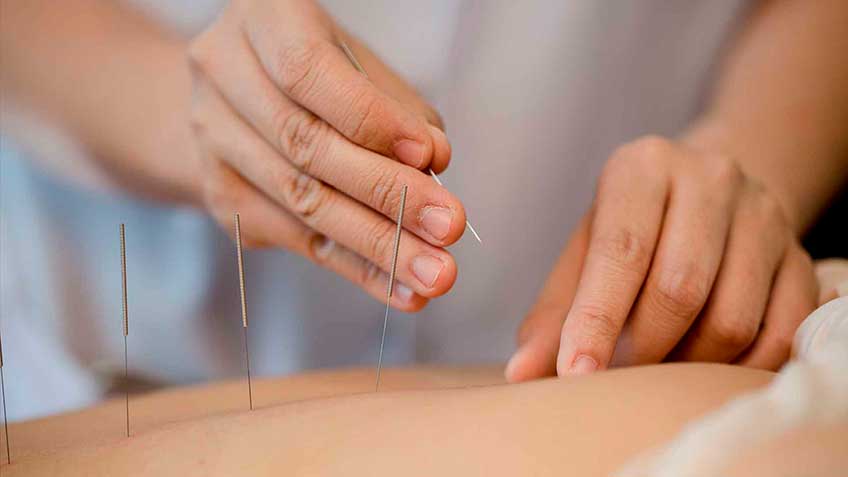 Acupuntura china, de lo ancestral a lo moderno.